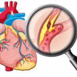 Colesterol alto: causas, riscos e como reduzir Colesterol alto: causas, riscos e como reduzir