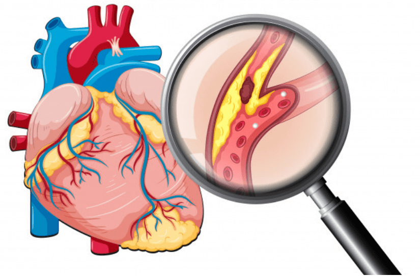 Colesterol alto: causas, riscos e como reduzir